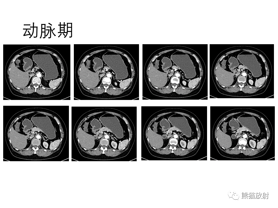 影像PPT - 【病例】正中弓状韧带综合征2例CT影像-9