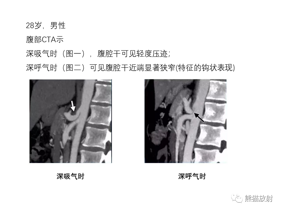 影像PPT - 【病例】正中弓状韧带综合征2例CT影像-17