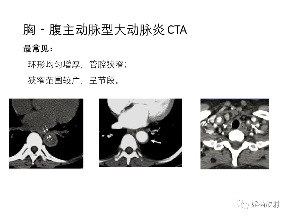 影像PPT - 【病例】正中弓状韧带综合征2例CT影像-23