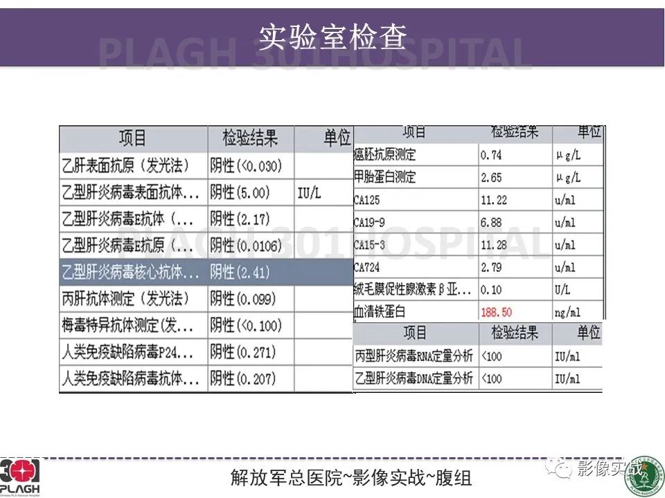 影像PPT - 【病例】肝细胞腺瘤1例MR影像-3