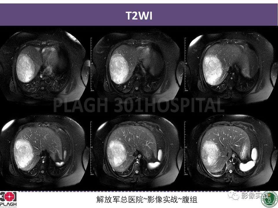 影像PPT - 【病例】肝细胞腺瘤1例MR影像-5