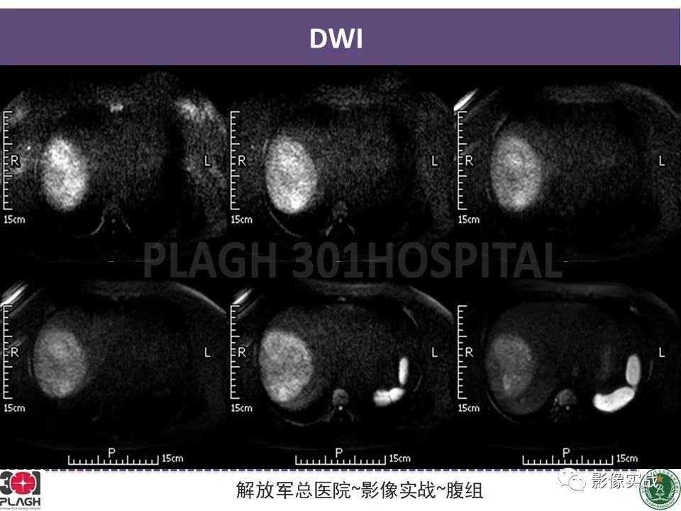 影像PPT - 【病例】肝细胞腺瘤1例MR影像-6