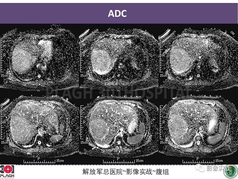影像PPT - 【病例】肝细胞腺瘤1例MR影像-7