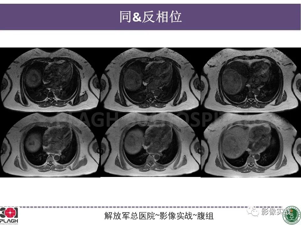 影像PPT - 【病例】肝细胞腺瘤1例MR影像-8