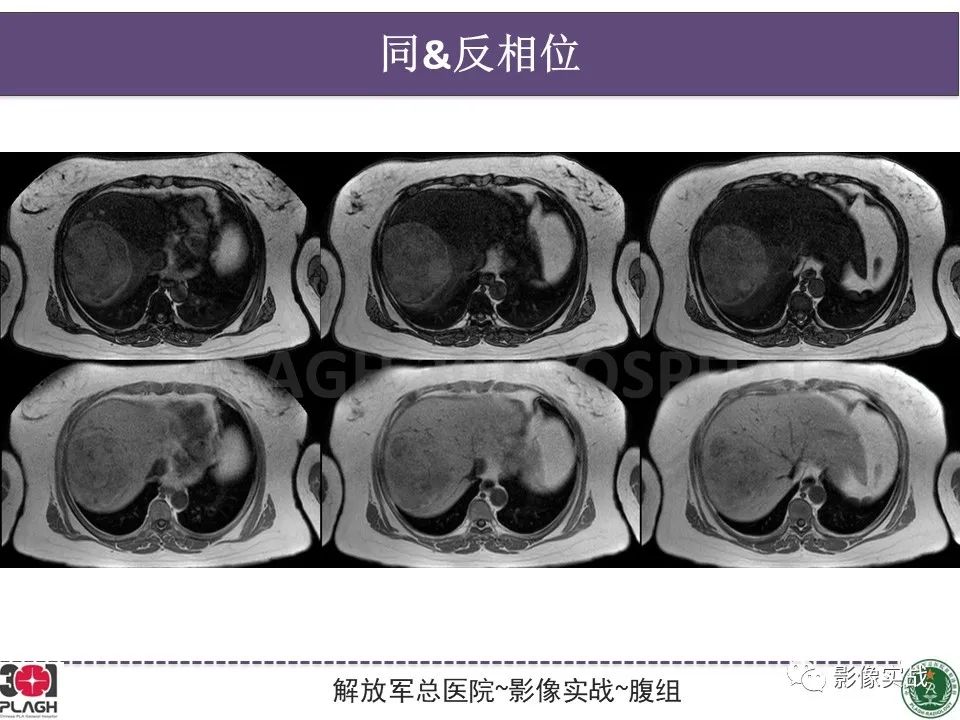 影像PPT - 【病例】肝细胞腺瘤1例MR影像-9