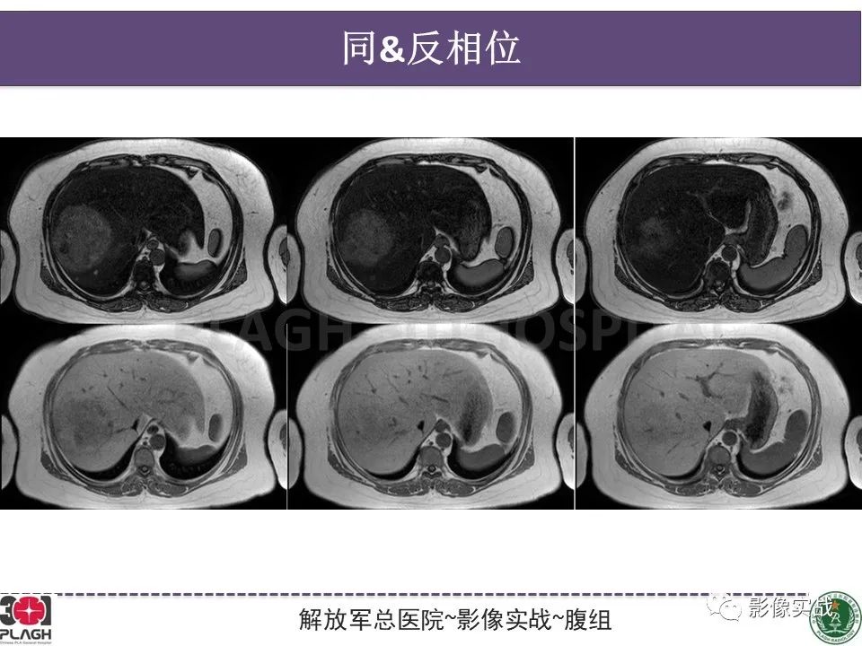 影像PPT - 【病例】肝细胞腺瘤1例MR影像-10