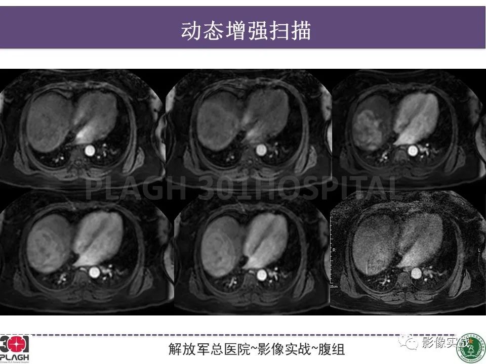 影像PPT - 【病例】肝细胞腺瘤1例MR影像-11
