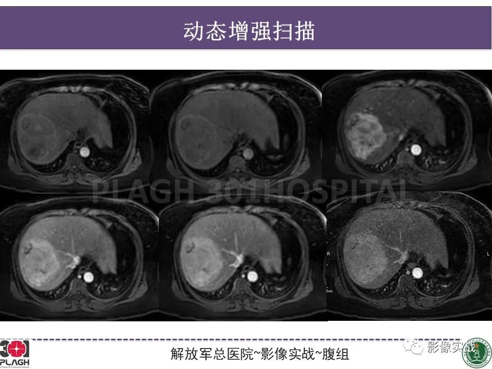 影像PPT - 【病例】肝细胞腺瘤1例MR影像-12