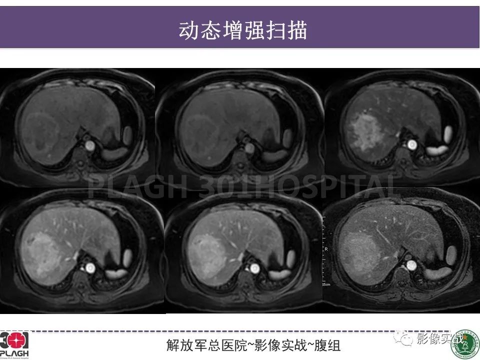 影像PPT - 【病例】肝细胞腺瘤1例MR影像-13