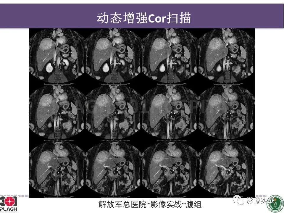 影像PPT - 【病例】肝细胞腺瘤1例MR影像-14