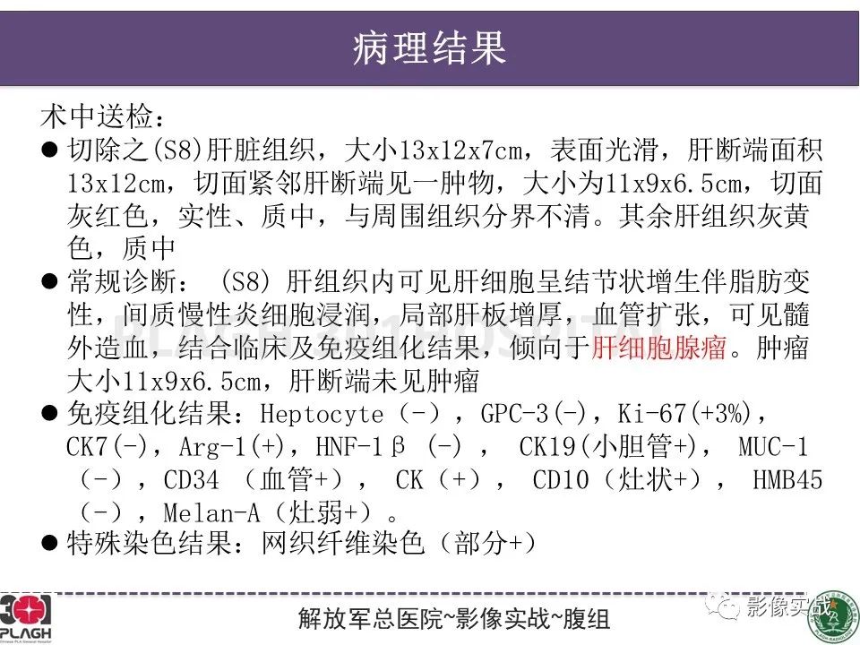 影像PPT - 【病例】肝细胞腺瘤1例MR影像-23