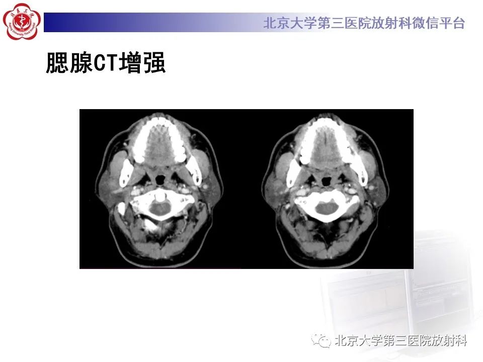 影像PPT - 【PPT】腮腺粘液表皮样癌-4