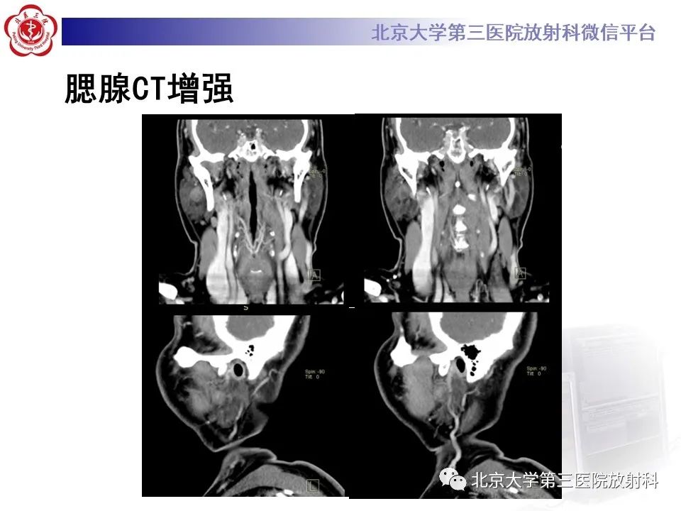 影像PPT - 【PPT】腮腺粘液表皮样癌-5
