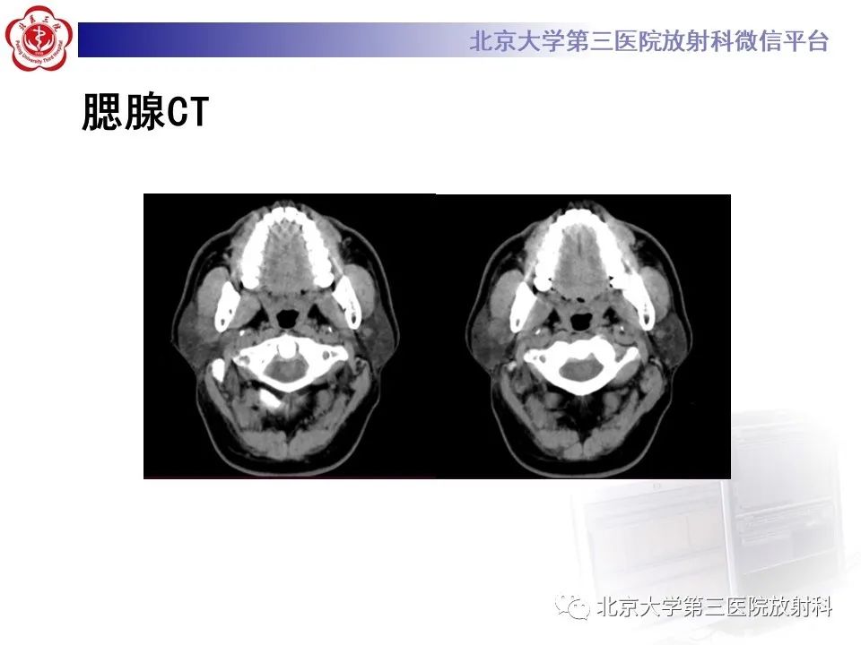 影像PPT - 【PPT】腮腺粘液表皮样癌-3