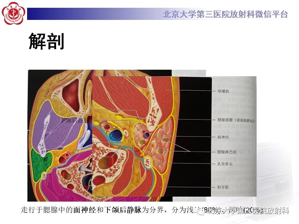 影像PPT - 【PPT】腮腺粘液表皮样癌-9