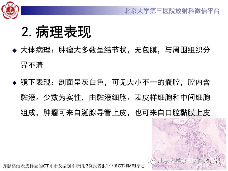 影像PPT - 【PPT】腮腺粘液表皮样癌-12