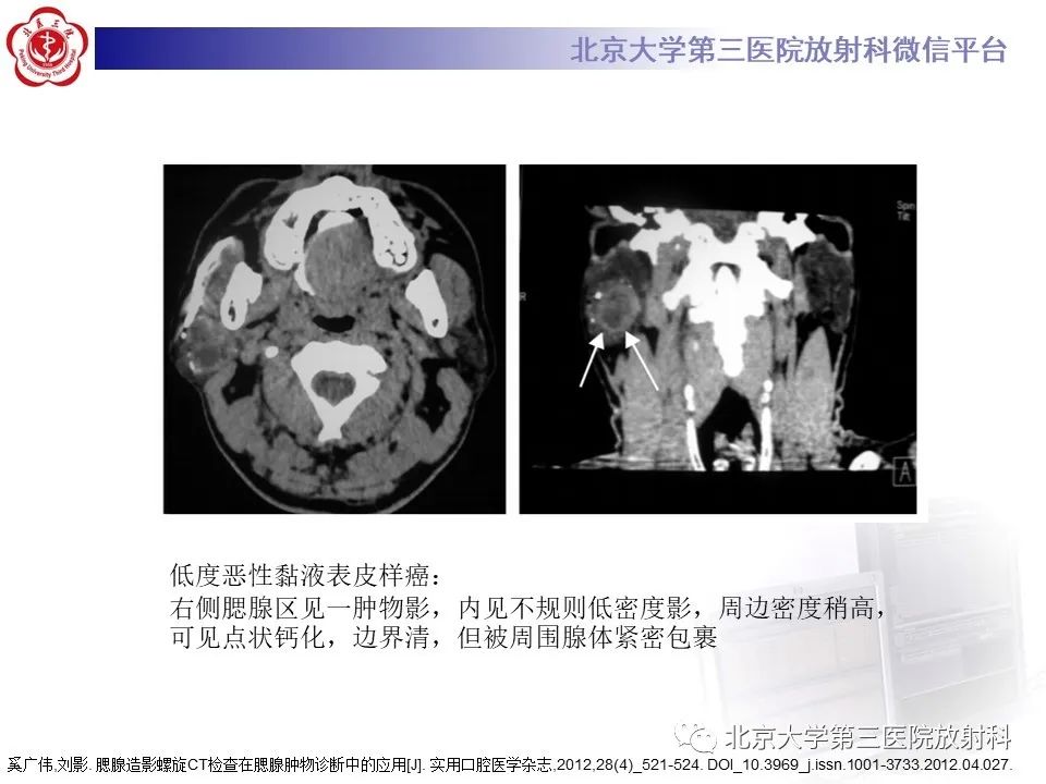 影像PPT - 【PPT】腮腺粘液表皮样癌-16