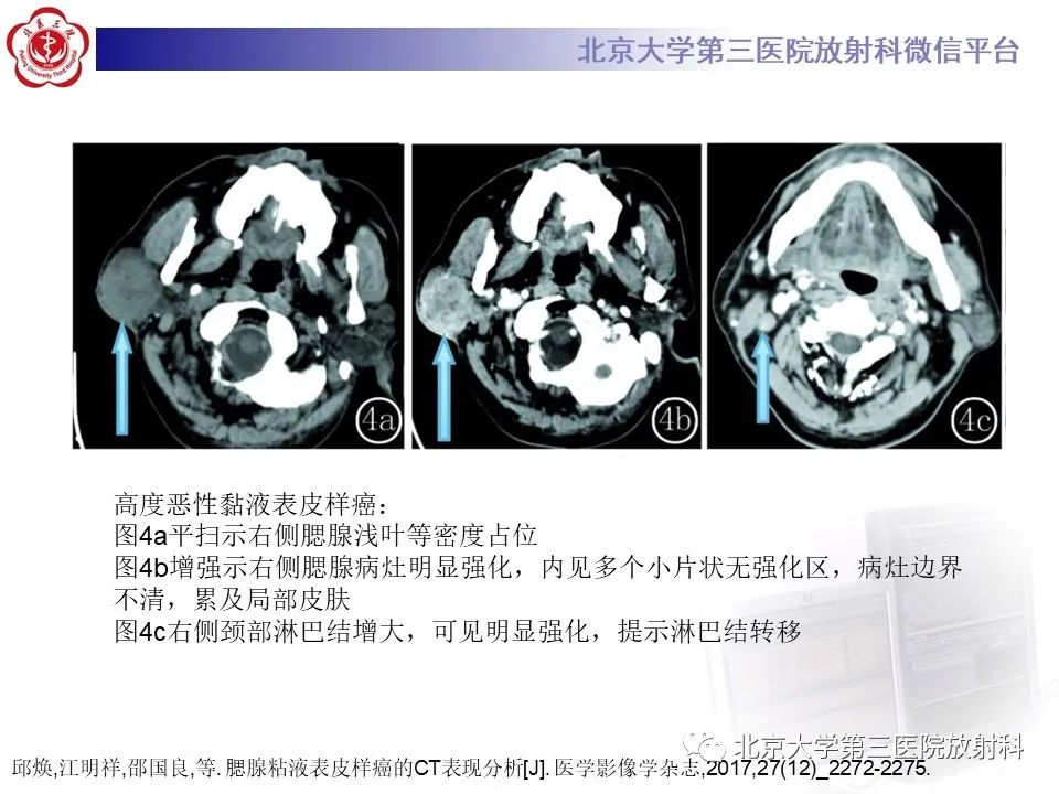 影像PPT - 【PPT】腮腺粘液表皮样癌-18
