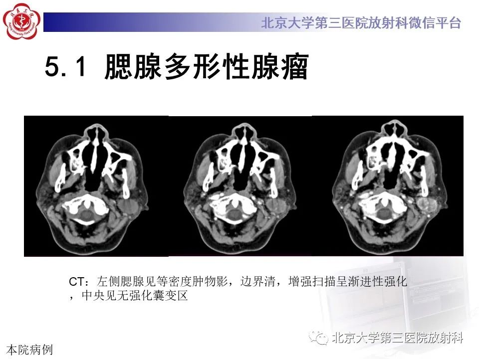 影像PPT - 【PPT】腮腺粘液表皮样癌-23