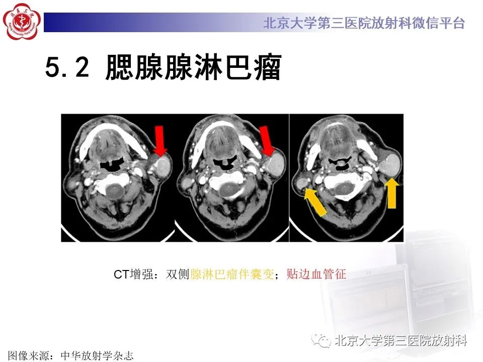 影像PPT - 【PPT】腮腺粘液表皮样癌-26