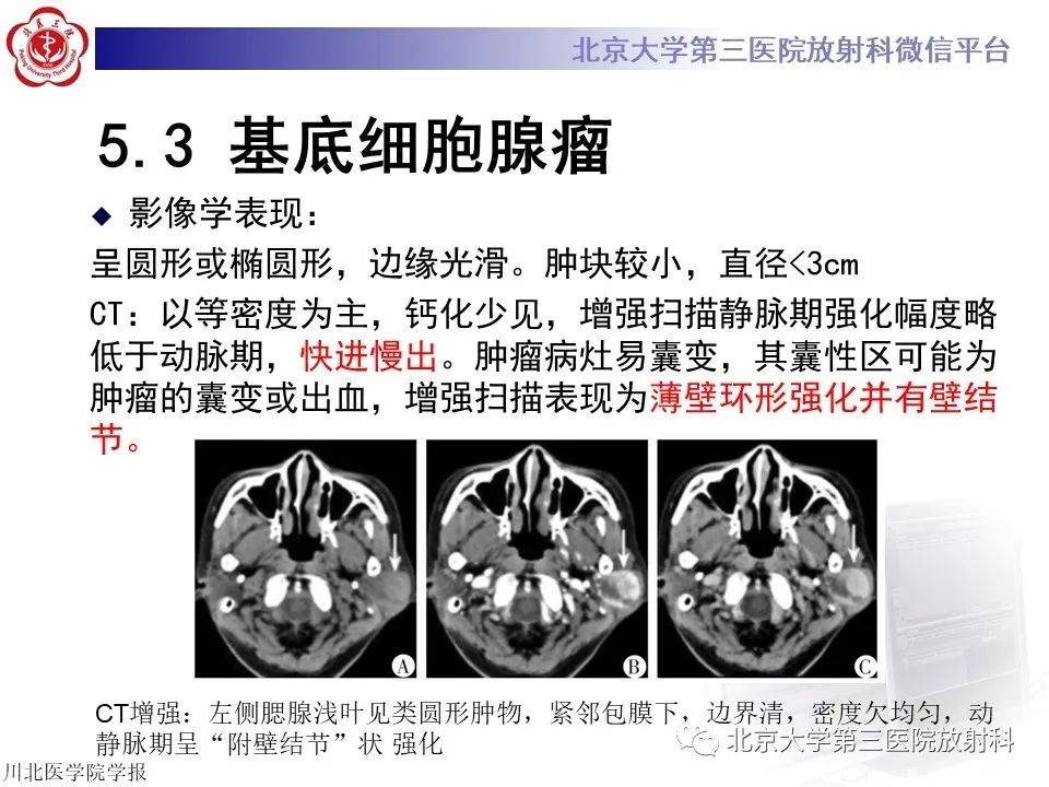 影像PPT - 【PPT】腮腺粘液表皮样癌-28