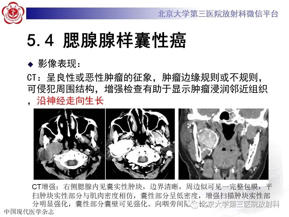 影像PPT - 【PPT】腮腺粘液表皮样癌-30