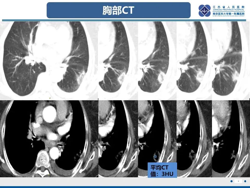 影像PPT - 【PPT】肺梗死-4