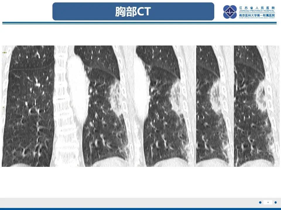 影像PPT - 【PPT】肺梗死-5