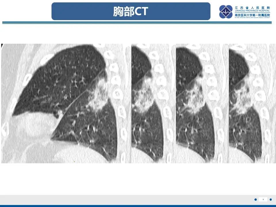 影像PPT - 【PPT】肺梗死-6
