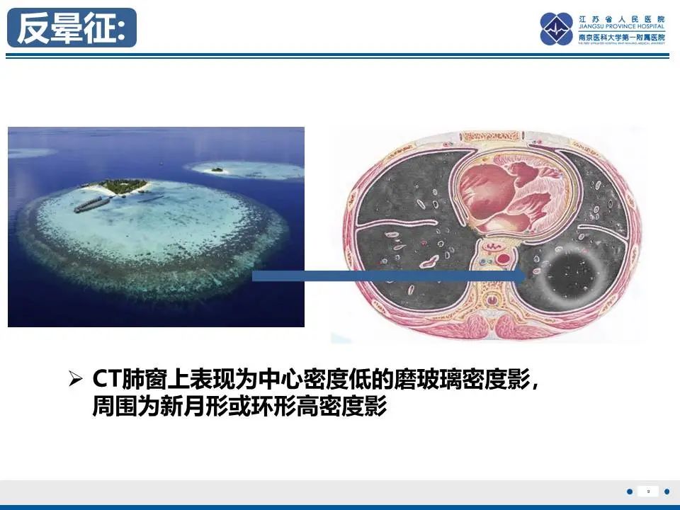 影像PPT - 【PPT】肺梗死-10