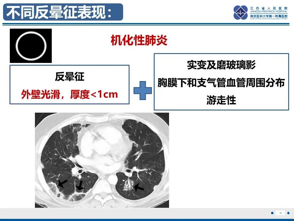 影像PPT - 【PPT】肺梗死-13