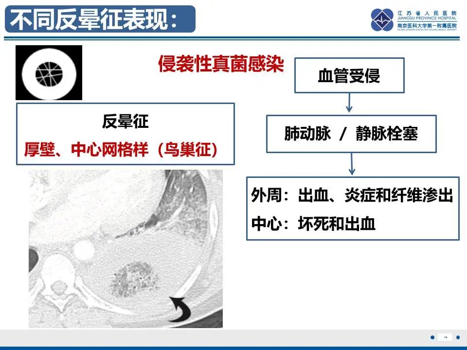 影像PPT - 【PPT】肺梗死-15