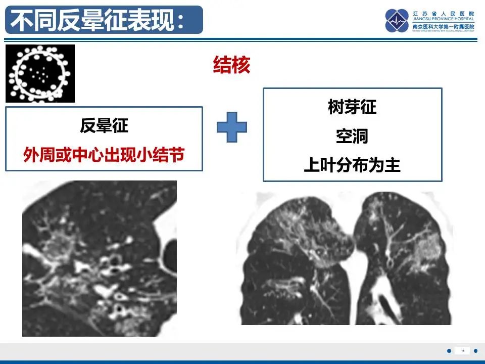 影像PPT - 【PPT】肺梗死-16
