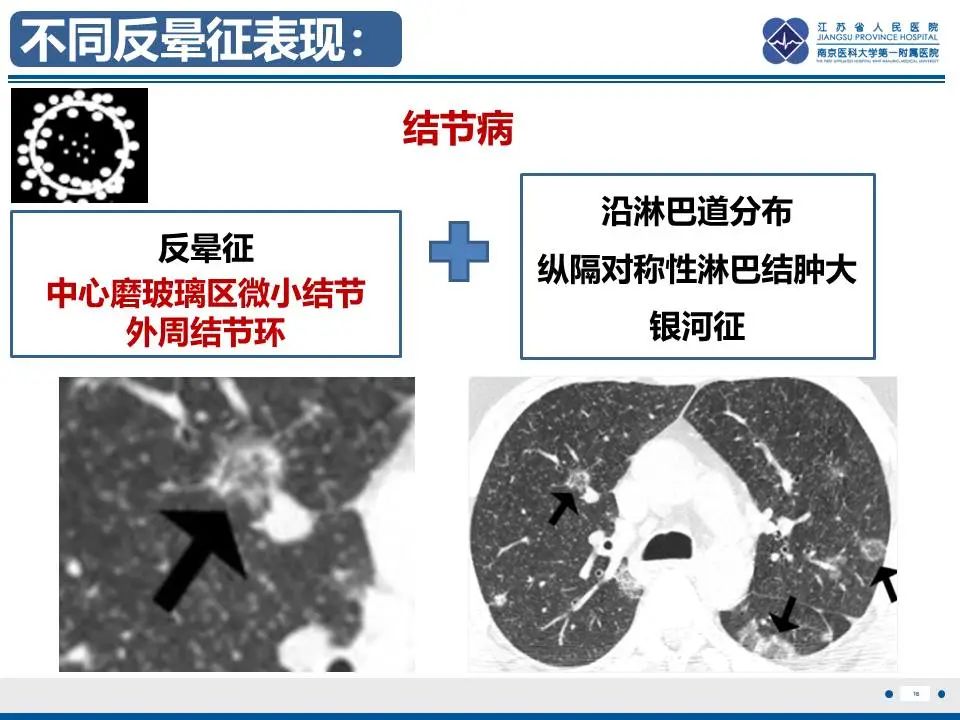 影像PPT - 【PPT】肺梗死-17