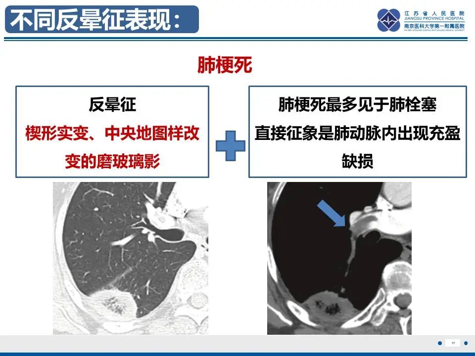 影像PPT - 【PPT】肺梗死-18