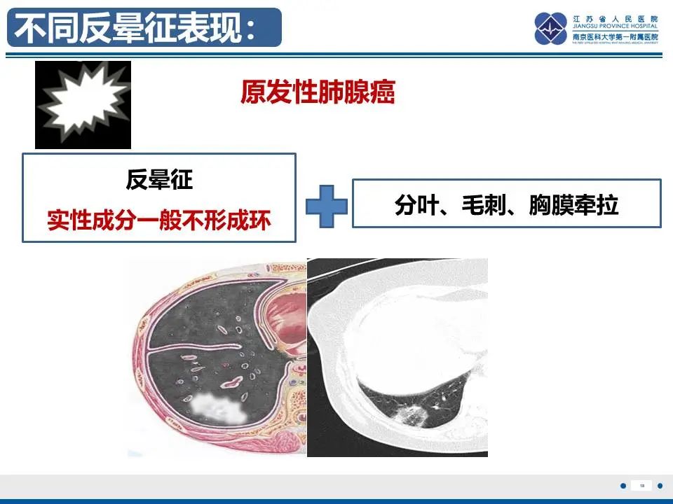 影像PPT - 【PPT】肺梗死-19