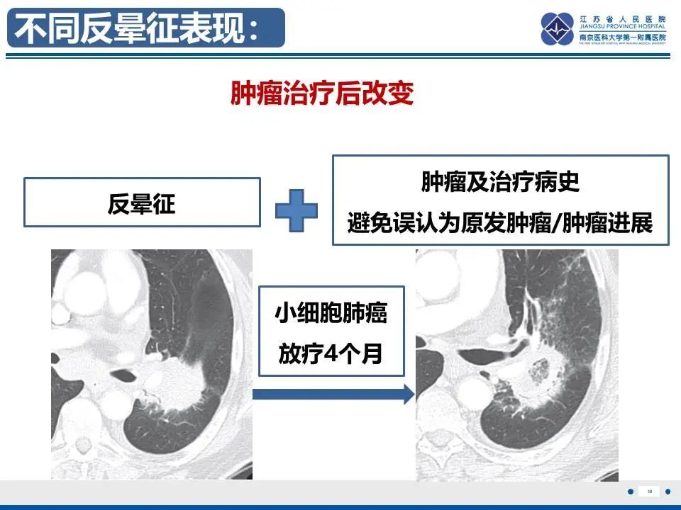 影像PPT - 【PPT】肺梗死-20
