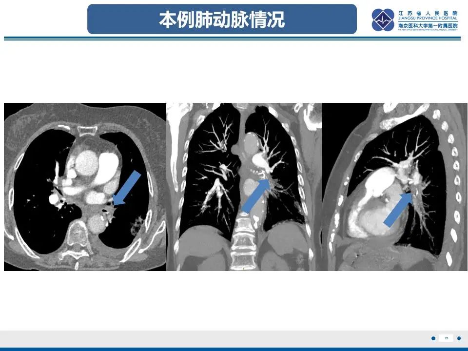 影像PPT - 【PPT】肺梗死-26