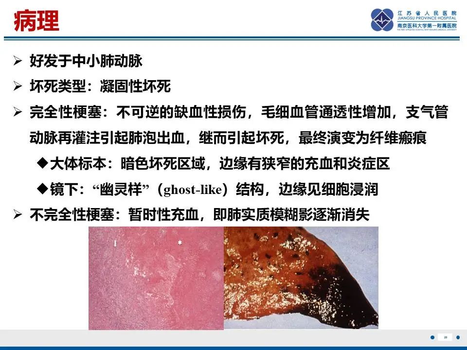 影像PPT - 【PPT】肺梗死-30
