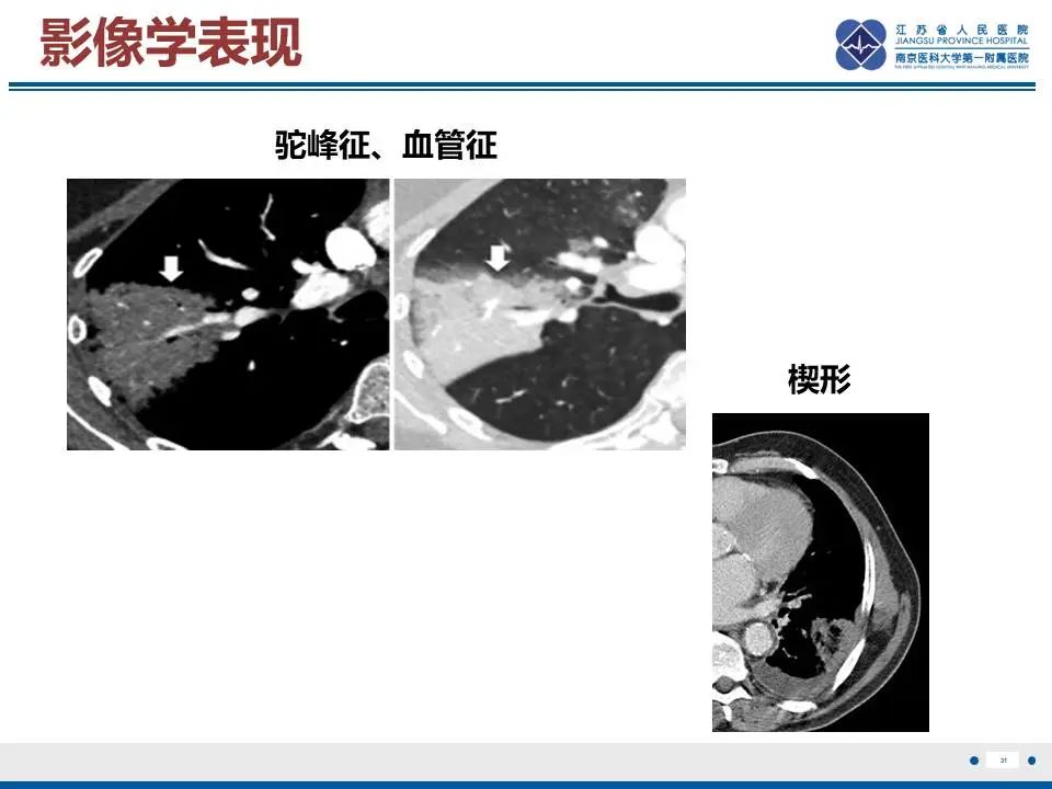 影像PPT - 【PPT】肺梗死-32
