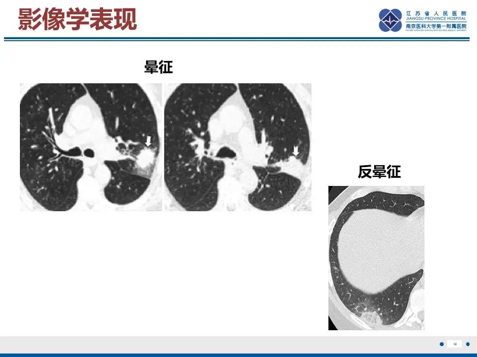 影像PPT - 【PPT】肺梗死-33