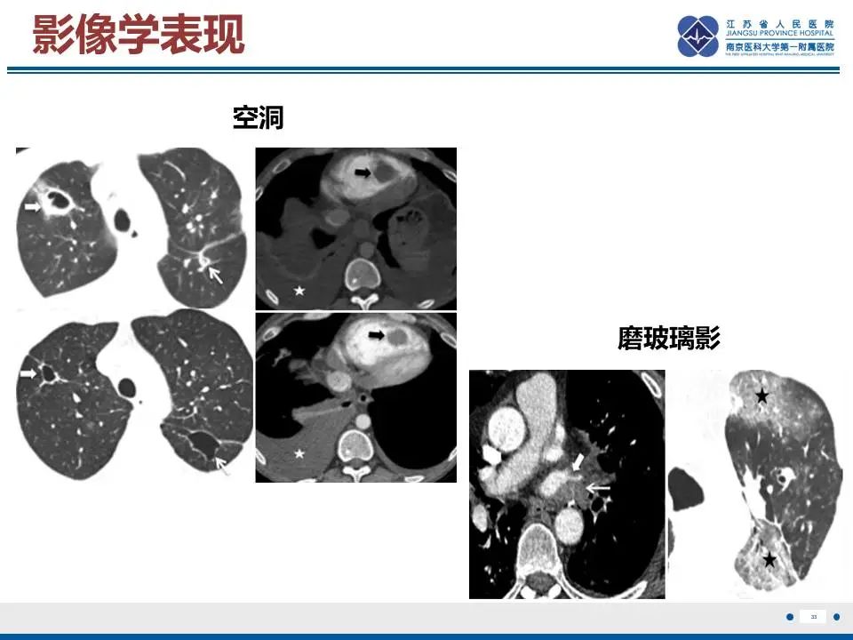 影像PPT - 【PPT】肺梗死-34