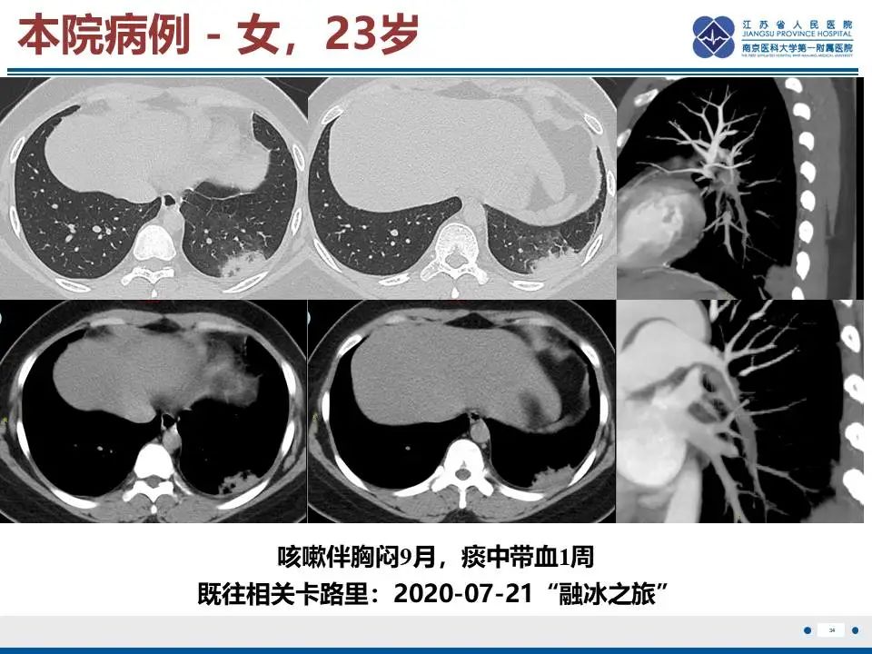 影像PPT - 【PPT】肺梗死-35