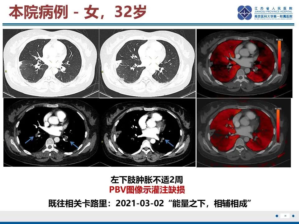 影像PPT - 【PPT】肺梗死-36