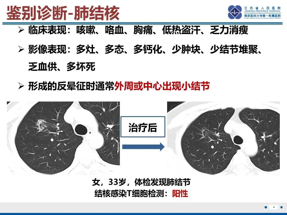 影像PPT - 【PPT】肺梗死-37