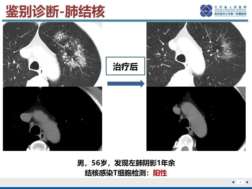 影像PPT - 【PPT】肺梗死-38