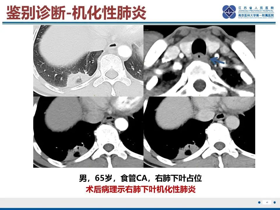 影像PPT - 【PPT】肺梗死-42