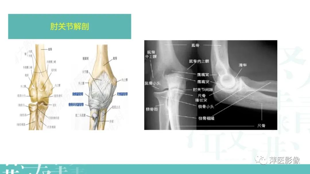 影像PPT - 【PPT】儿童肘关节损伤X线表现-3
