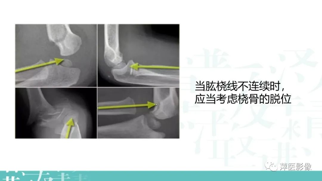 影像PPT - 【PPT】儿童肘关节损伤X线表现-7