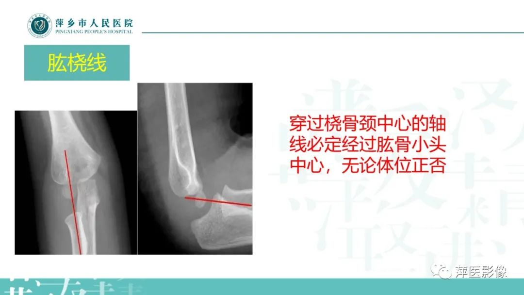影像PPT - 【PPT】儿童肘关节损伤X线表现-6